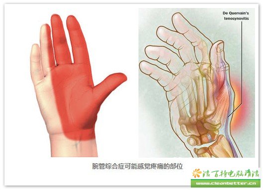 IT工作者时髦病“RSI”——（重复性使力伤害）